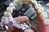 Зубы решили печатать на 3D принтере