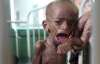 Сомалийские дети мрут от голода