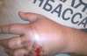 Хлопцю за футболку "Спасибо жителям Донбасса" прострелили руку