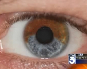 Калифорнийский ученый лазером меняет цвет глаз за 20 минут