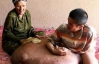 Вьетнамцу удалили 90-килограммовую опухоль