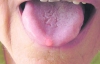 Рак язика виникає від зубних протезів