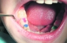 У молочні зуби ставлять кольорові пломби