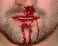 На Запоріжжі чоловік розбив обличчя судді, вдаривши його головою