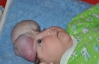 8-місячний Толя Боровський живе без черепа