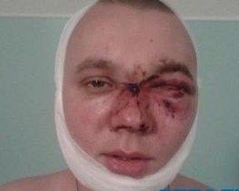 Відвідувача криворізького нічного клубу били 7 охоронців: хлопцю пробили череп і вибили око