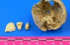 В Италии найдена самая древняя "зубастая опухоль"