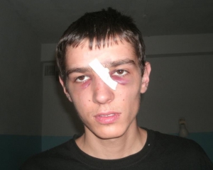 Сторонники Партии регионов в Енакиево сломали нос местном лидеру &quot;Свободы&quot;