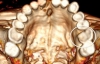 Науковці дослідили хвороби зубів найдавнішої мумії
