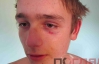 В Тернополе жестоко избили 16-летнего парня, его родители обвиняют милицию