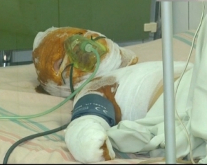 В Одесі жінка ненароком підпалила 10-річну дочку