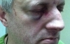 "Тітушки" зламали ніс і пошкодили око харківському "євромайдановцю"