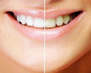 Чому виникають жовті зуби: причини і фактори впливу