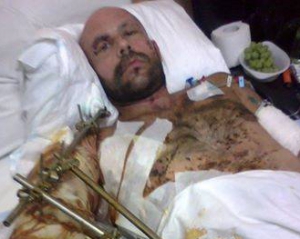 Роман Ганецкий получил ранения во время минометного обстрела в Марьинке