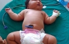 В Индии родилась "самая тяжелая" в мире девочка