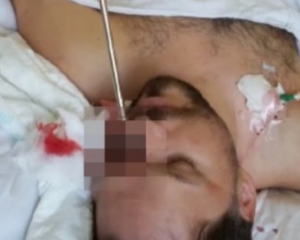 В Одесской области мужчина прострелил себе глаз гарпуном