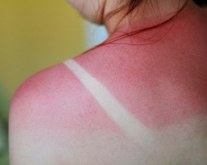 Алергія на сонце зникає після масок з глини