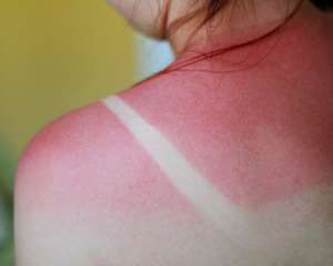 Алергія на сонце зникає після масок з глини