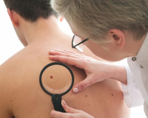 Рак шкіри розвивається з родимки після відвідування сауни