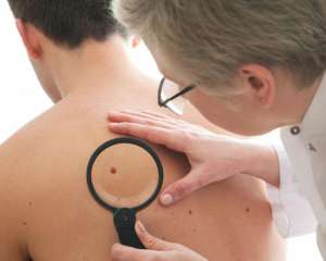 Рак кожи развивается с родинки после посещения сауны