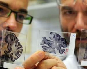 Вчені знайшли ген хвороби Альцгеймера