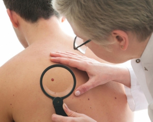 Нерівні родимки можуть бути ознакою раку шкіри