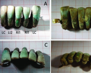 В Італії знайшли зубний протез епохи Середньовіччя