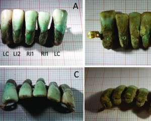 В Італії знайшли зубний протез епохи Середньовіччя