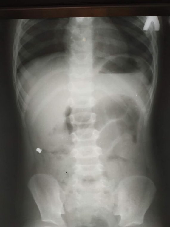 У Львові 6-річний хлопчик проковтнув кулю для гвинтівки