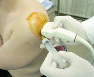При ортоплазмі тромбоцити вводять у зону ураження під контролем ультразвукового сканера