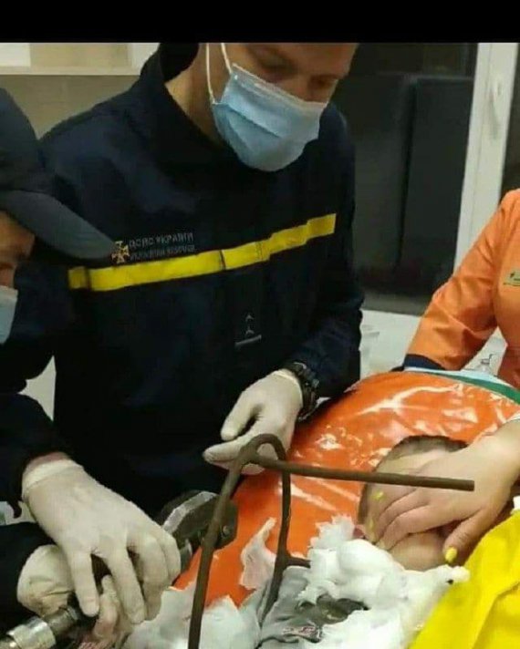 На  Полтавщині    6-річний хлопчик упав на перевернутий металевий стілець. Шматок арматури пронизав йому шию. Дитина в реанімації