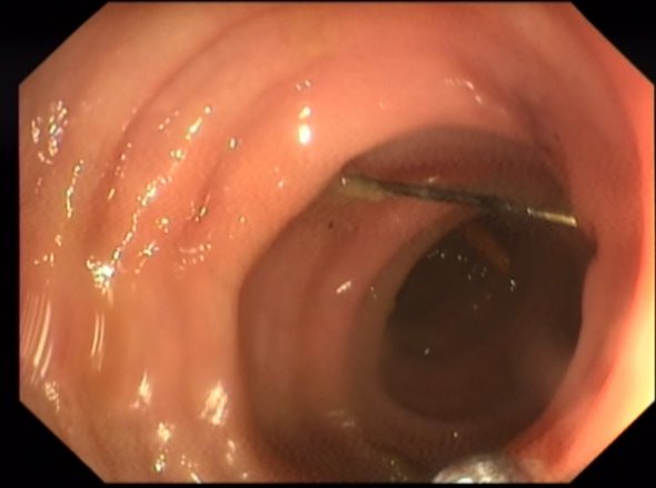 Голка обома краями вп'ялася в стінку кишки