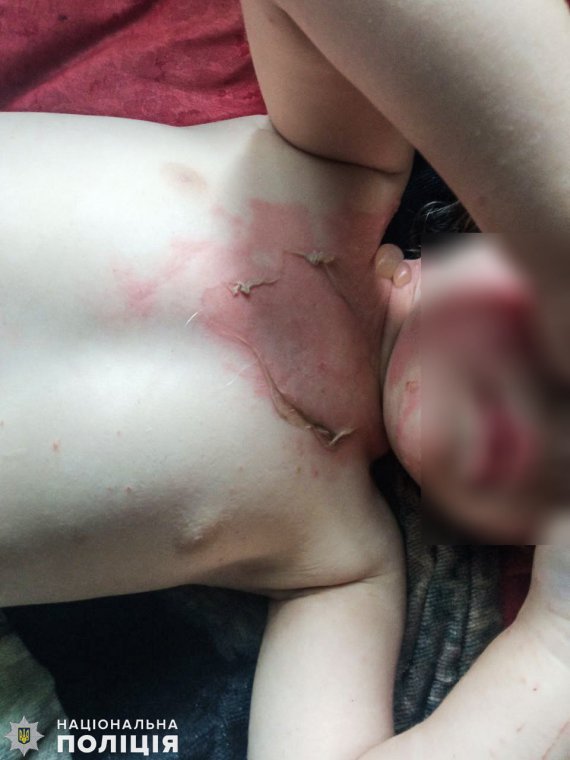 На Миколаївщині    2-річна дівчинка обварилася окропом.   Проте мати  не везла доньку в лікарню