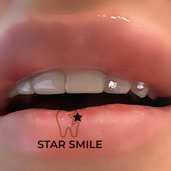 В студии Star Smile можно выбрать скайс на зуб различных фирм и цветов