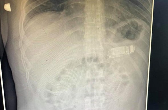 Рентген легень жителя Косово, який "з'їв" мобільний телефон