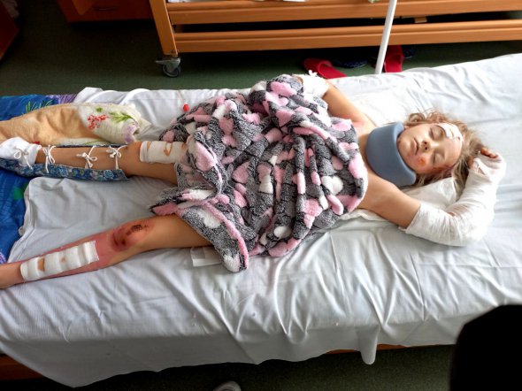 9-летнюю Дарью Царь из Смелы Черкасской области 31 августа сбили жигули. Ребенок получил открытую черепно-мозговую травму, перелом таза, ушиб легких и живота, вывих бедра, перелом ребер и левой руки. Под правой - глубокая рваная рана. На лечение и реабилитацию нужна помощь.
