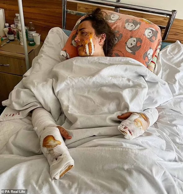 Лидия Макарчук получила осколочные ранения, которые изуродовали ее тело