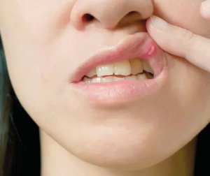 При хронічному стоматиті набрякають мигдалини, болить голова, сверблять ясна, бульбашки стають червоними