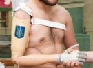 Василь Пелеш, якому росіяни ще 2014 року відрубали руку за тризуб, помер у лікарні після чергового поранення