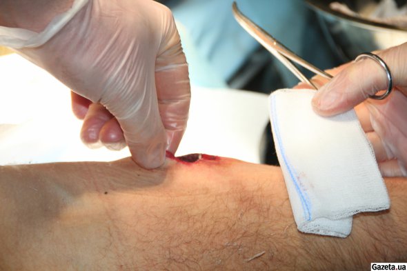 Лікарі стабпункту щодня стикаються з ранами, що кровоточать