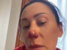 Філатова показала, чим обернулося для неї сходження на найвищу вершину Антарктиди.