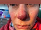 Філатова показала, чим обернулося для неї сходження на найвищу вершину Антарктиди.