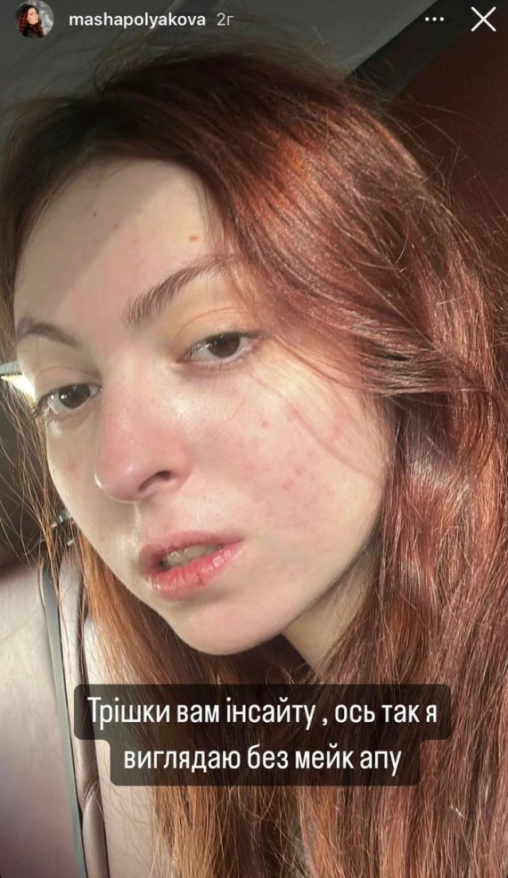 Маша Полякова показала результат боротьби з акне