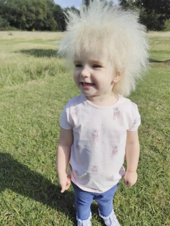 3-річна Лейла Девіс живе з рідкісним синдромом "нерозчесаного волосся". Через цю особливість дівчинку порівнюють з Борисом Джонсоном, а друзі називають "Пухнастиком"