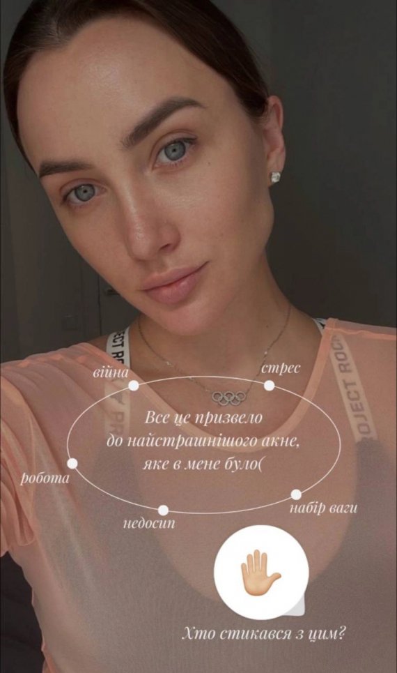 Анна Ризадинова рассказала, как лечила акне
