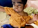 Филиппинец 2-летний Джарен Гамонган имеет редкую аномалию – одну на миллиард. Врачей обнаружили у него болезнь под названием гипертрихоз 