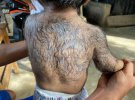 Філіппінець 2-річний Джарен Гамонган має рідкісну аномалію - одну на мільярд. Лікарів виявили в нього хвороба під назвою гіпертрихоз