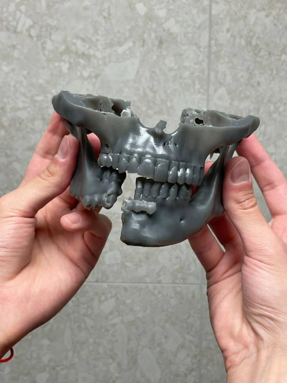 Анатомическая модель перелома челюсти