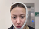Екатерина Репьяхова вставила имплант в подбородок