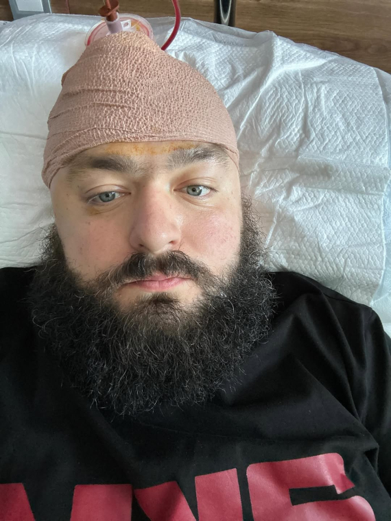 Після другої операції та встановлення титанової пластини у череп Вєня з "Ліги сміху" продовжує реабілітацію з незмінним почуттям гумору